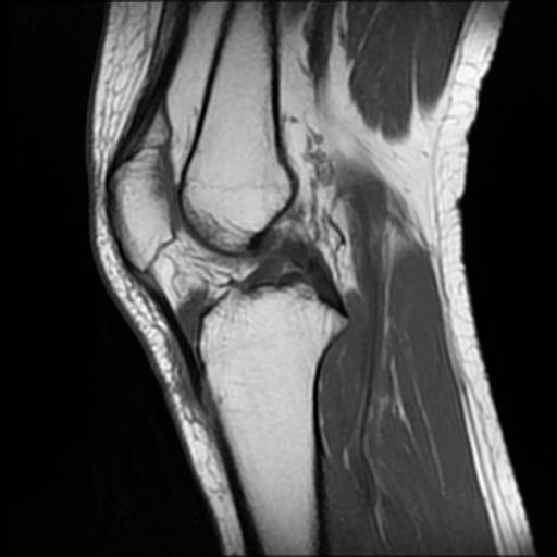 Hoffa's fat pad ganglion cyst | Image | Radiopaedia.org