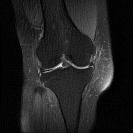 Hoffa's fat pad ganglion cyst | Image | Radiopaedia.org