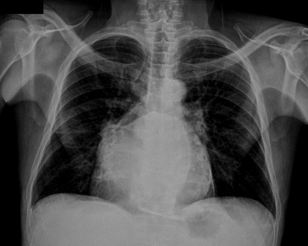 Pericardial calcification | Image | Radiopaedia.org