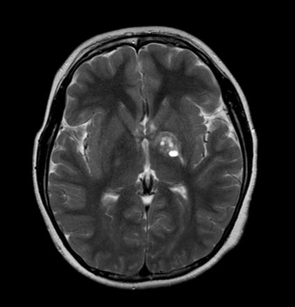 Basal ganglia germinoma | Image | Radiopaedia.org