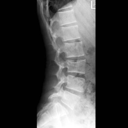 Langerhans cell histiocytosis with vertebra plana | Image | Radiopaedia.org