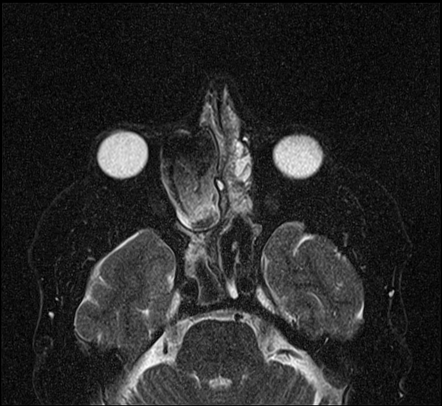 Ethmoid mucocele with proptosis | Image | Radiopaedia.org