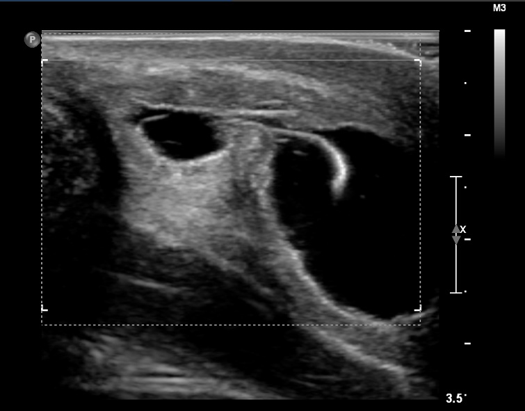 Urethral Stricture Causes Symptoms Diagnosis Urethral