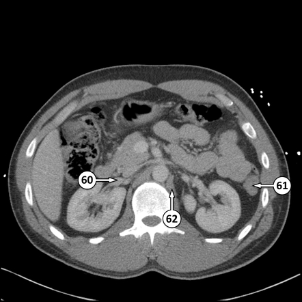 Renal vein | Radiology Reference Article | Radiopaedia.org