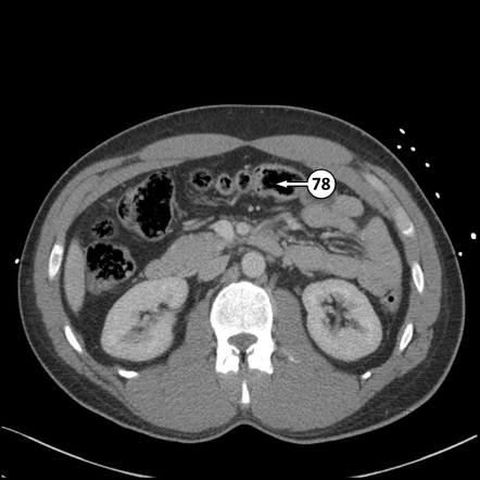 Transverse Colon Radiology Reference Article Radiopaedia Org