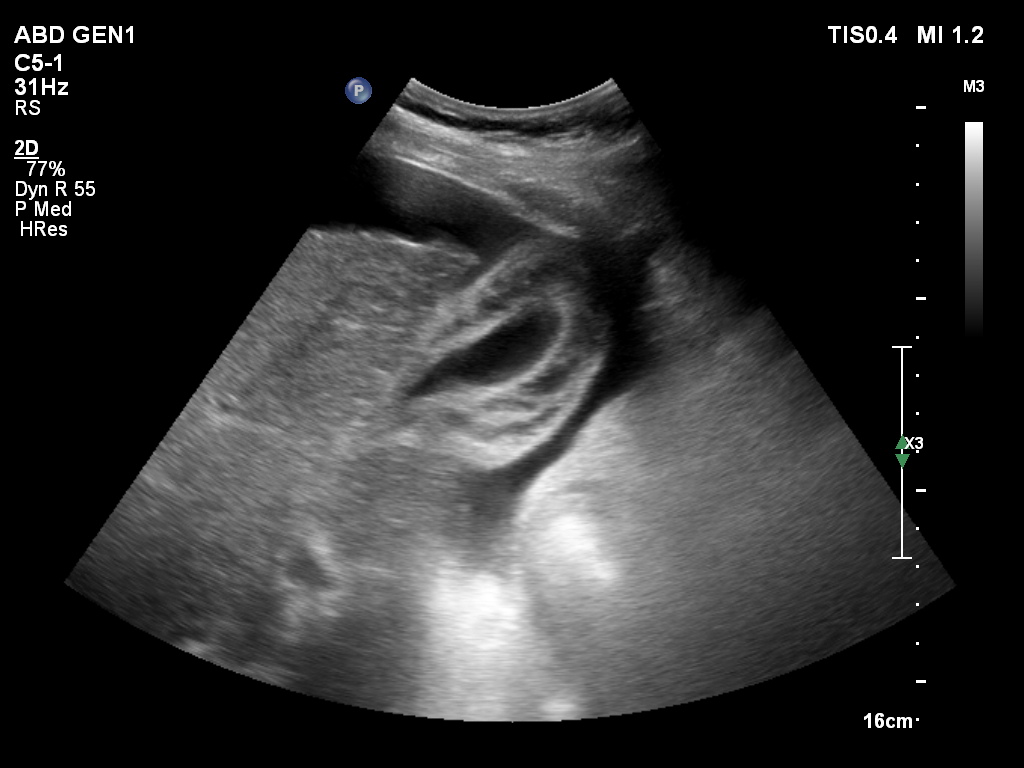 Reactive gallbladder wall thickening | Image | Radiopaedia.org