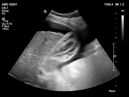 Reactive gallbladder wall thickening | Image | Radiopaedia.org