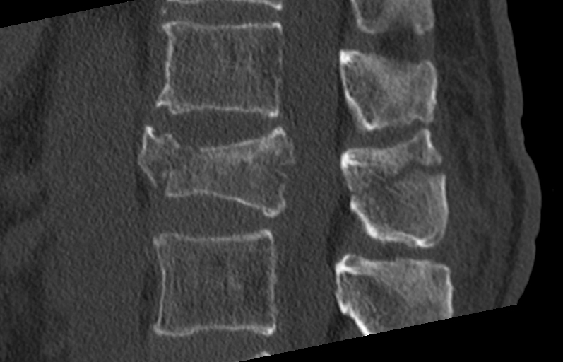 Unstable L1 burst fracture | Image | Radiopaedia.org