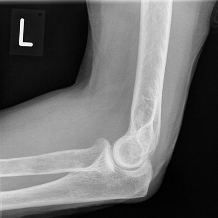 Renal carcinoma metastasis | Radiology Case | Radiopaedia.org