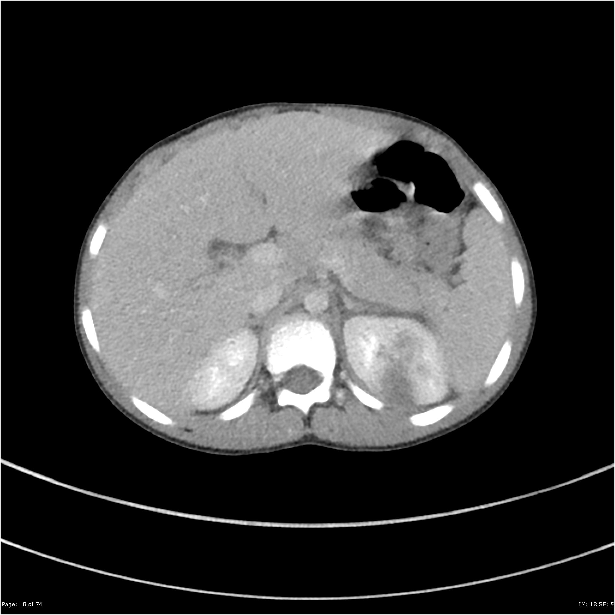 Multifocal Pyelonephritis Image