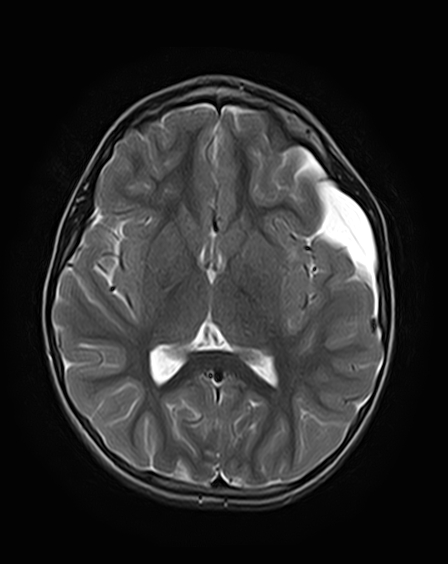 Spontaneous Arachnoid Cyst Rupture With Subdural Hygroma Image 0203