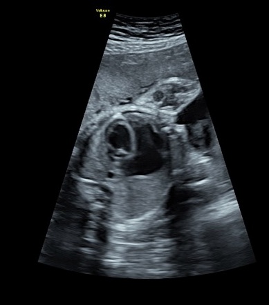 Endocardial fibroelastosis | Radiology Case | Radiopaedia.org