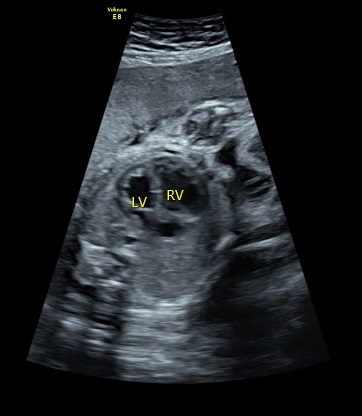 Endocardial fibroelastosis | Image | Radiopaedia.org