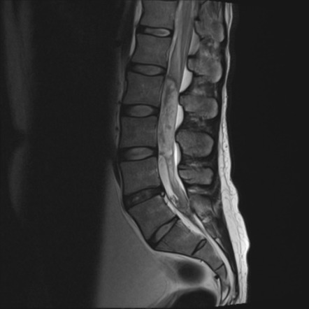 Myxopapillary Ependymoma With Hemorrhage 