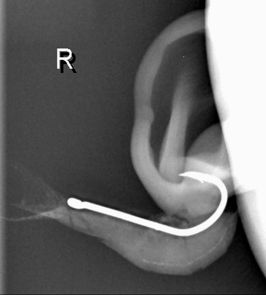 Hook With Prawn In Pinna Radiology Case Radiopaedia Org