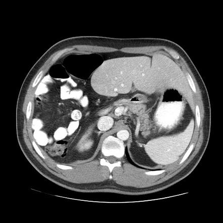 Wandering liver | Radiology Case | Radiopaedia.org