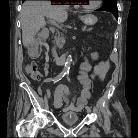 Pelvic Kidney Radiology Reference Article Radiopaedia Org