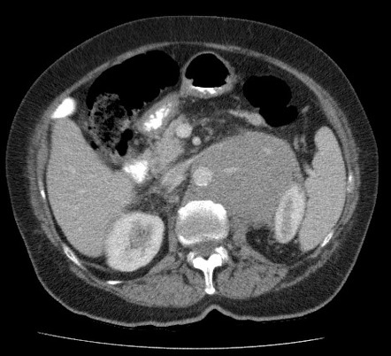 Hypovascular retroperitoneal lesions | Radiology Reference Article ...