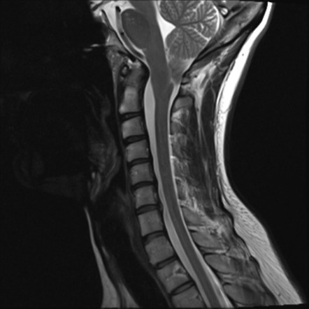 Chiari 1.5 malformation | Radiology Case | Radiopaedia.org