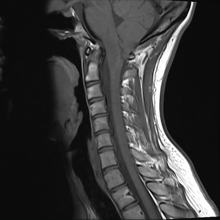 Chiari 1.5 malformation | Image | Radiopaedia.org