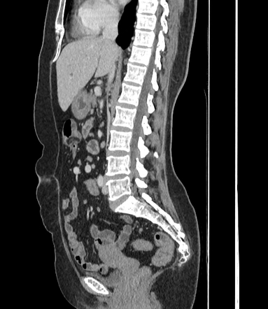 Incomplete Intestinal Malrotation | Image | Radiopaedia.org