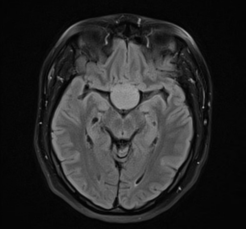 Pituitary Macroadenoma | Image | Radiopaedia.org