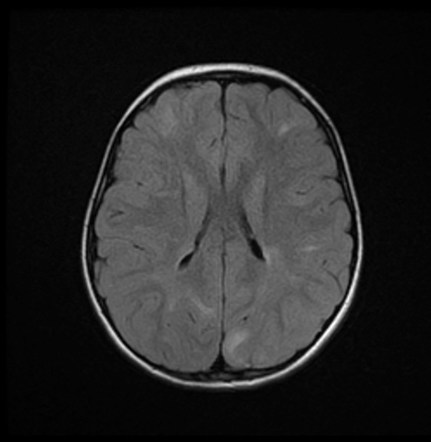 Tuberous sclerosis | Radiology Case | Radiopaedia.org