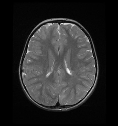 Tuberous sclerosis | Image | Radiopaedia.org