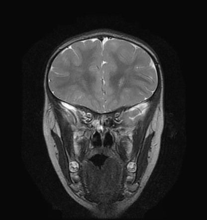 Subependymal hamartoma | Radiology Reference Article | Radiopaedia.org