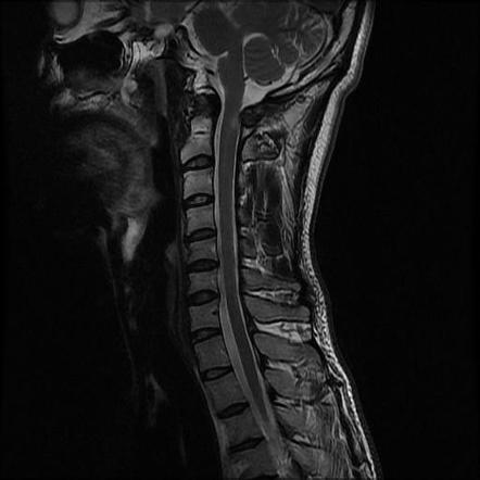 Atlas fracture | Radiology Case | Radiopaedia.org