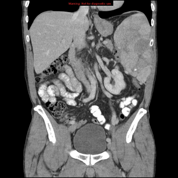 Rhabdomyosarcoma | Image | Radiopaedia.org