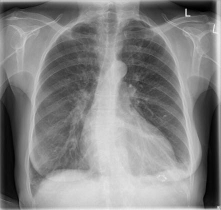 Splenic embolization | Radiology Reference Article | Radiopaedia.org