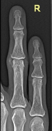 Acute calcific periarthritis | Radiology Reference Article ...