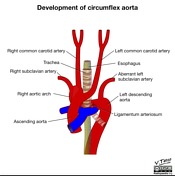 Circumflex aorta | Radiology Reference Article | Radiopaedia.org