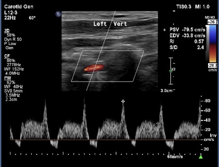 Common carotid artery occlusion with partial subclavian steal syndrome ...