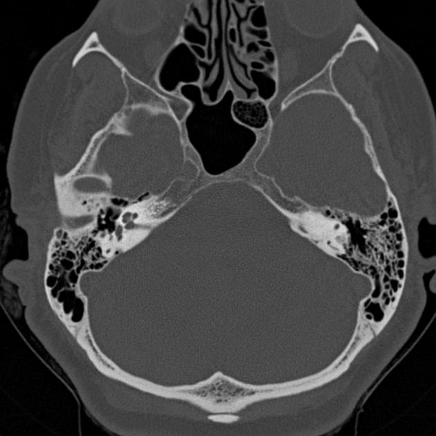 Fenestral Otosclerosis Radiology Case Radiopaedia Org