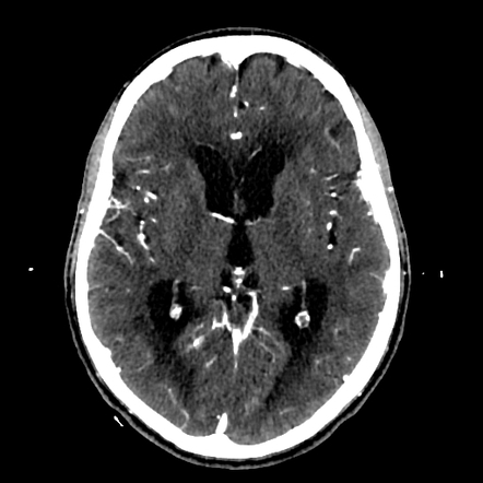 Solitary cerebellar metastasis from lung tumor | Radiology Case ...