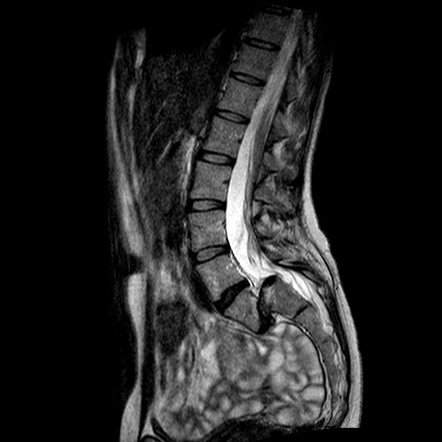 spondylolisthesis radiology