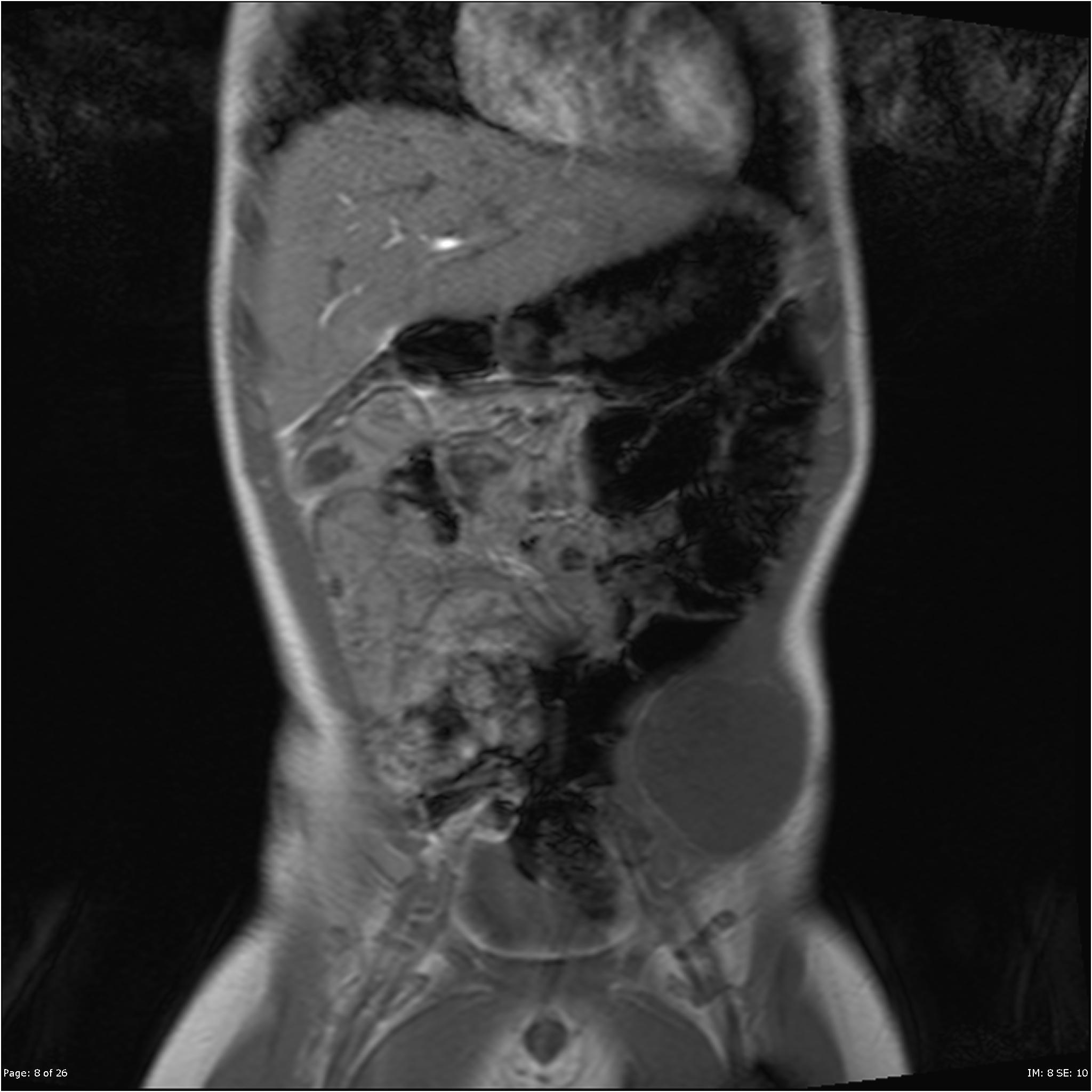 sarcoma abdominal sintomas