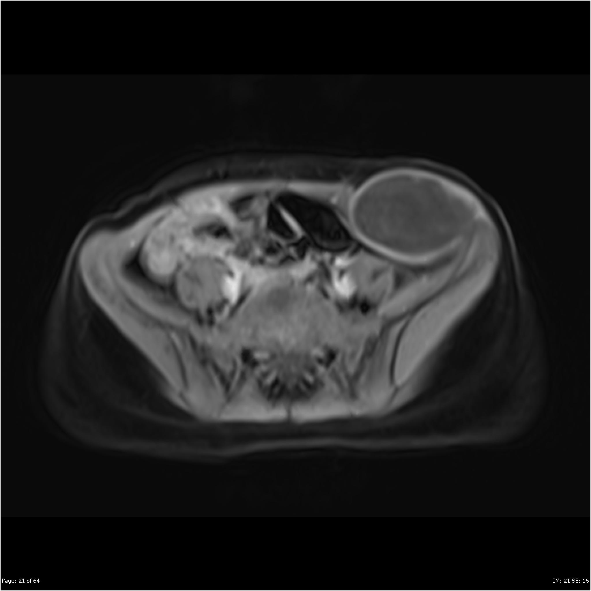 Undifferentiated Abdominal Wall Sarcoma Image