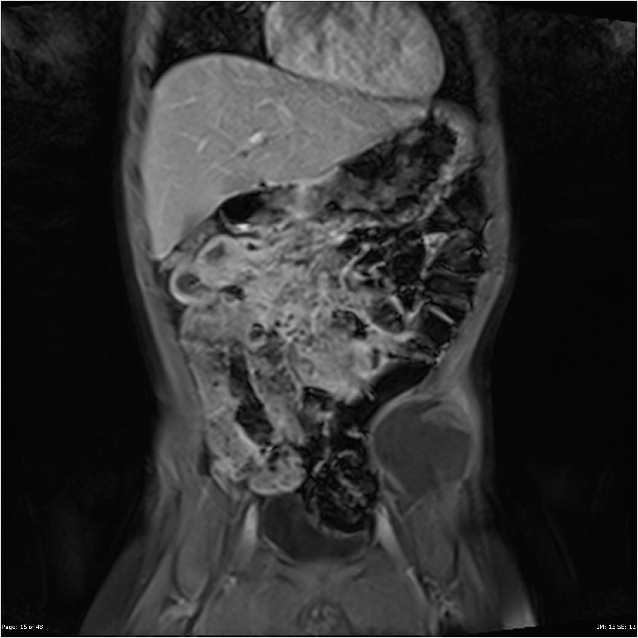 Undifferentiated Abdominal Wall Sarcoma Image