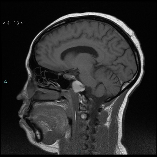 Cholesterol granuloma of the petrous apex | Image | Radiopaedia.org