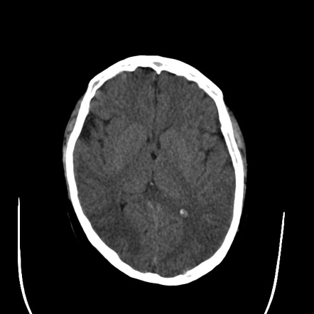 Multiple Myeloma Raindrop Skull Image Radiopaedia Org