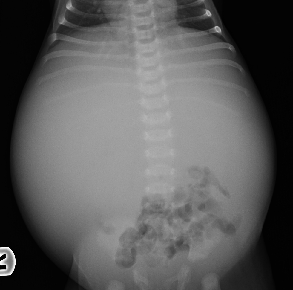 neonatal neuroblastoma presentation