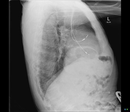 Diaphragmatic Eventration Radiology Reference Article Radiopaedia Org