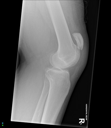 Patellar tendon rupture | Radiology Case | Radiopaedia.org