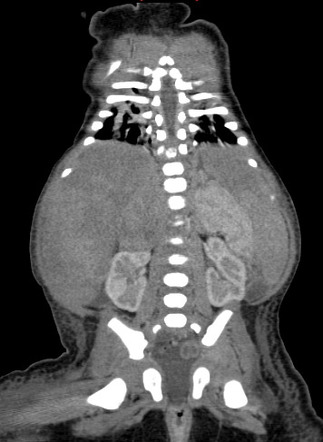 neonatal neuroblastoma presentation