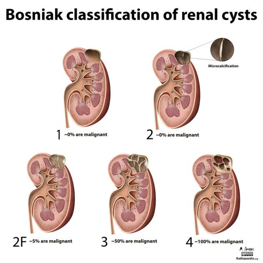 Bosniak Renal Cyst Type Iv Radiology Case Radiopaedia Org