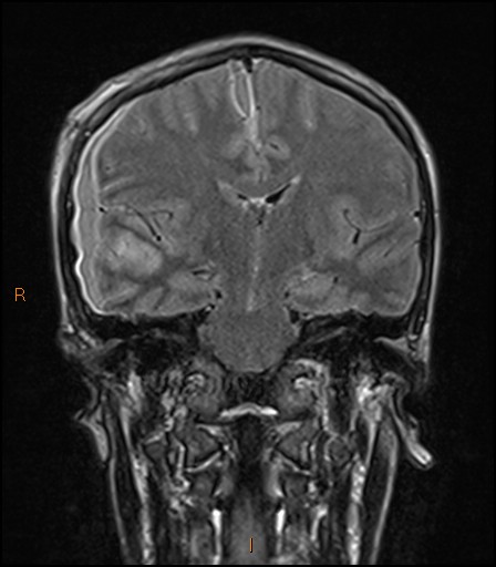 Subdural Empyema And Frontal Abscess Complicating Frontal Sinusitis