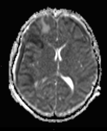 Subdural empyema and frontal abscess complicating frontal sinusitis ...